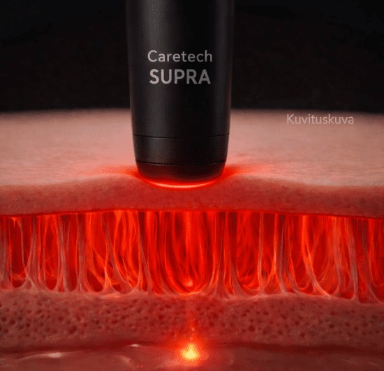 Caretech SUPRA